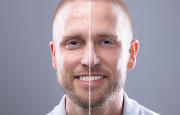 a man face after having Microneedling | Radio Frequency Microneedling | Radio Frequency Microneedling Can Help Transform Your Skin | Here's How With Secret RF