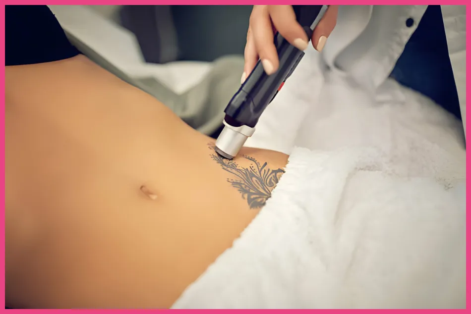 laser hair removal-1