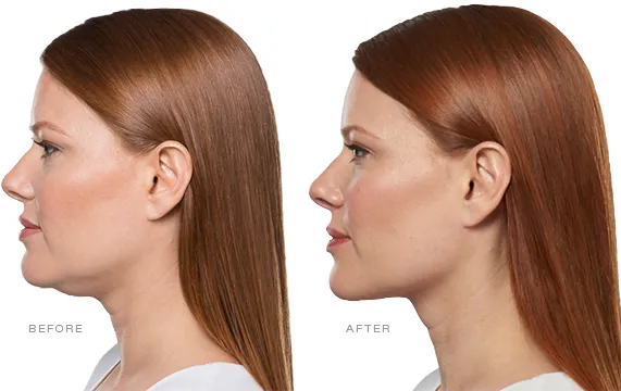 Kybella