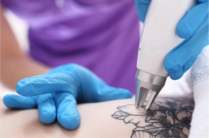 Tattoo Removal by Elite Body and Laser in Lewis Center, OH