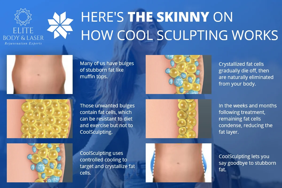 Coolsculpting in Lewis Center, OH by Elite Body & Laser