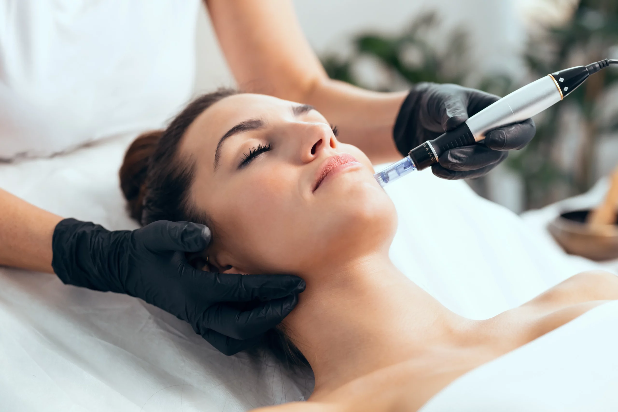 Microneedling in Lewis Center, OH by Elite Body & Laser