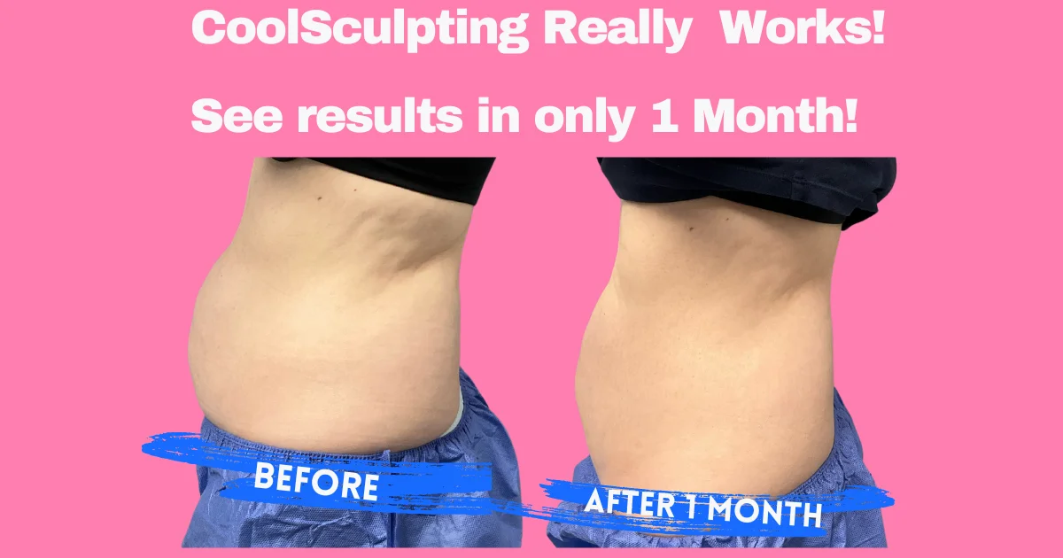 Coolsculpting before and after results in Lewis Center, OH by Elite Body & Laser