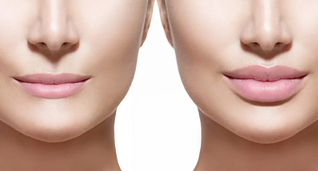 Juvederm Filler in Lewis Center, OH by Elite Body & Laser