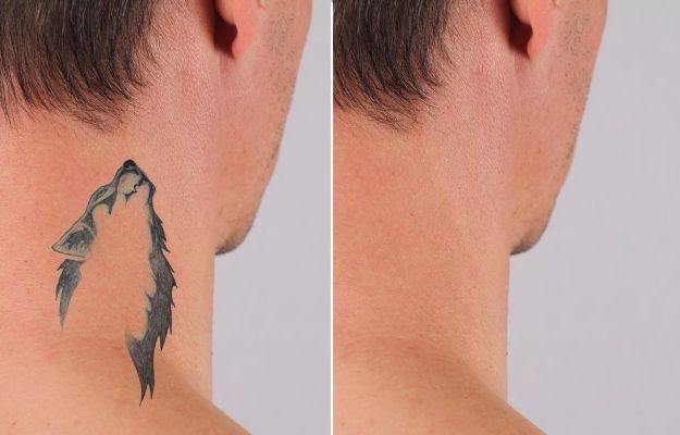 a man's neck before and after taking tattoo removal treatment | How does Enlighten by Cutera work?