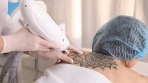a women is having tattoo removal treatment | Feature | Enlighten By Cutera: The Best Laser Tattoo Removal (How It Works)
