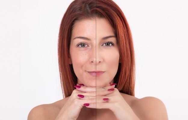 face of one woman before and after using the treatment | 5 Ultherapy Benefits For Looking Younger