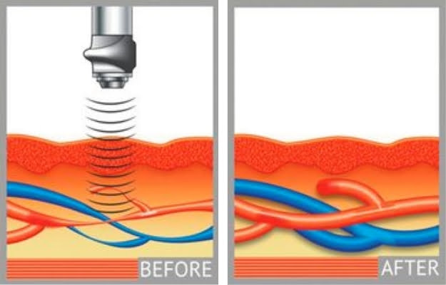 how Gainwave treatment works | Gainswave Procedure: How it Works | Gainswave Benefits: How This New Device Helps With ED