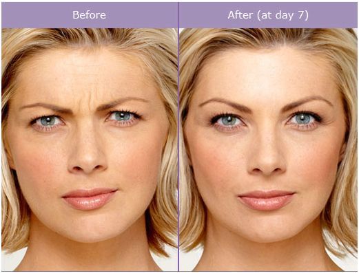 Botox in Columbus OH Reduce Fine Lines Wrinkles Safe