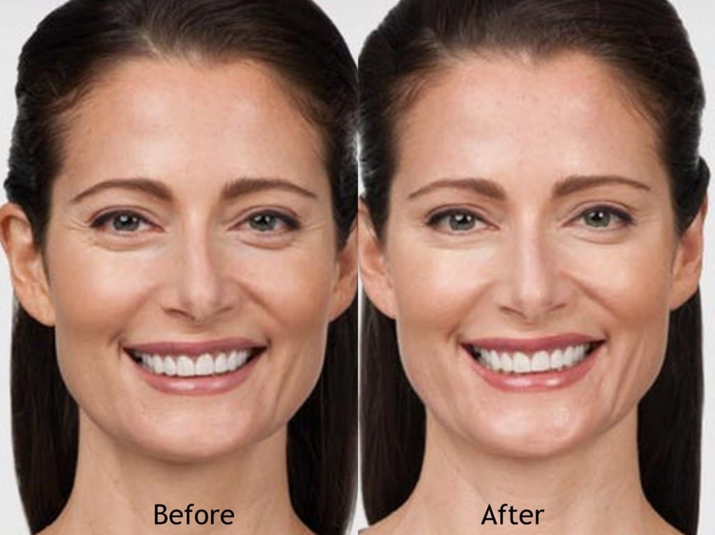 Botox in Columbus OH Reduce Fine Lines Wrinkles Safe