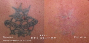 laser-tattoo-removal-before-and-after-4