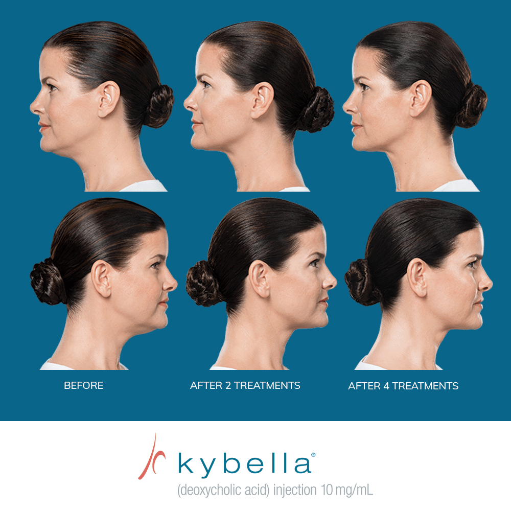 kybella-2-ba_16