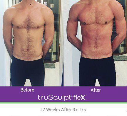 trusculpt-flex-before-and-after-7-640w