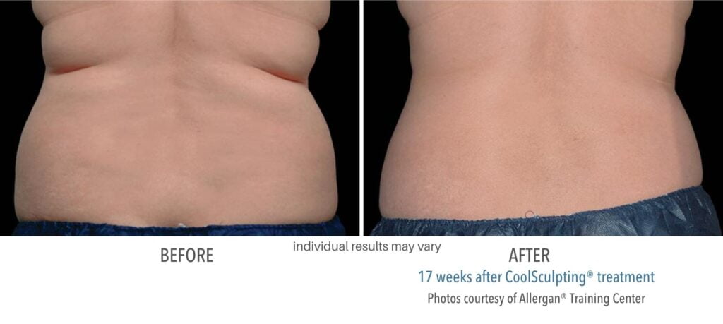 coolsculpting_before_and_after2
