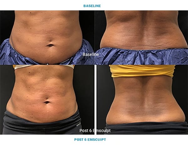 emsculpt-musels-burn-fat-ba5-z