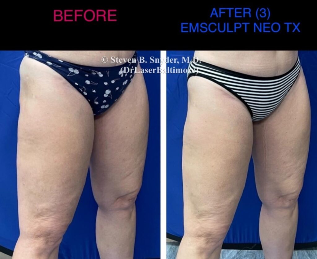 emsculpt_neo_laser_doc_md_before_and_after_16