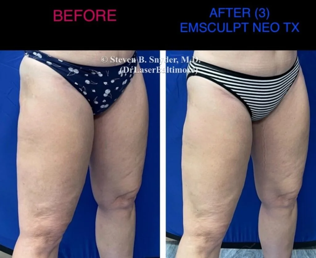 Emsculpt Neo Hips and Thighs Treatment Acton