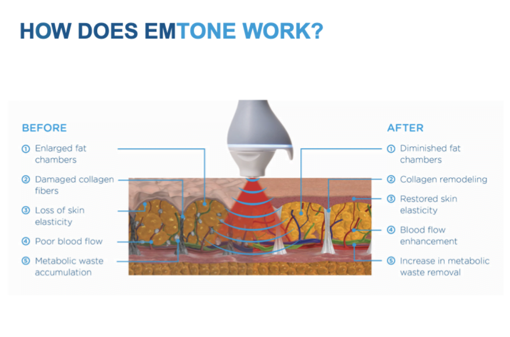 emtone-how-it-works-1024×677