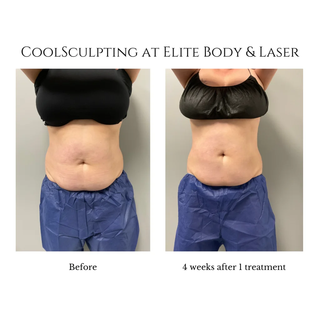 CoolSculpting Elite Before and After  New Treatment + Better Results —  Emerson Medical