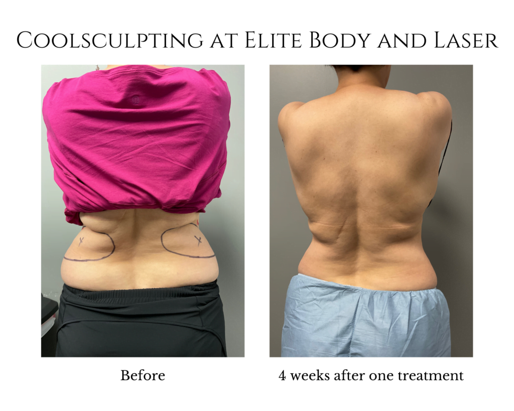 Coolsculpting at Elite Body and Laser
