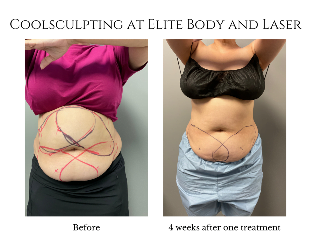 Coolsculpting at Elite Body and Laser (2)