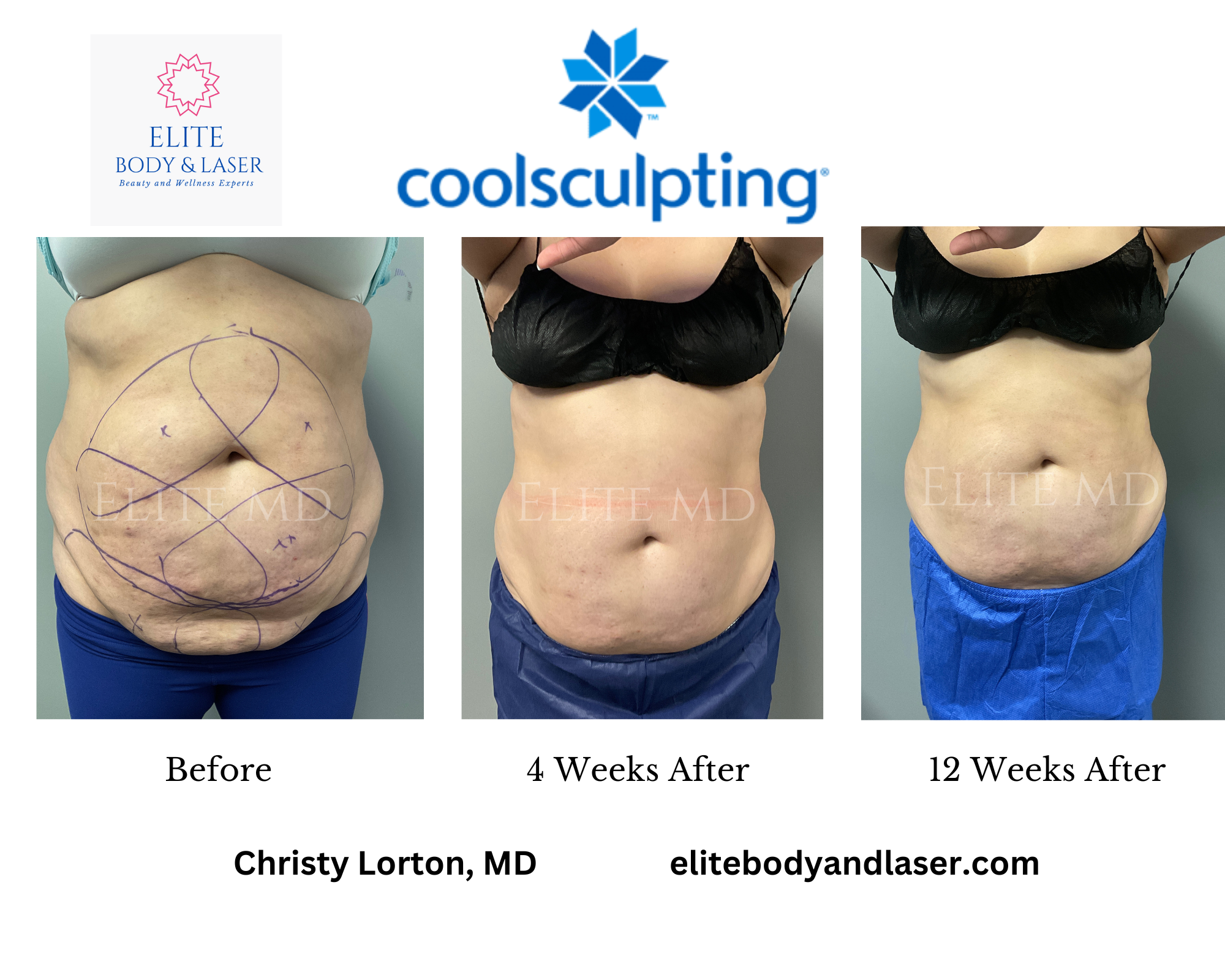 CoolSculpting at Elite Body and Laser (2)