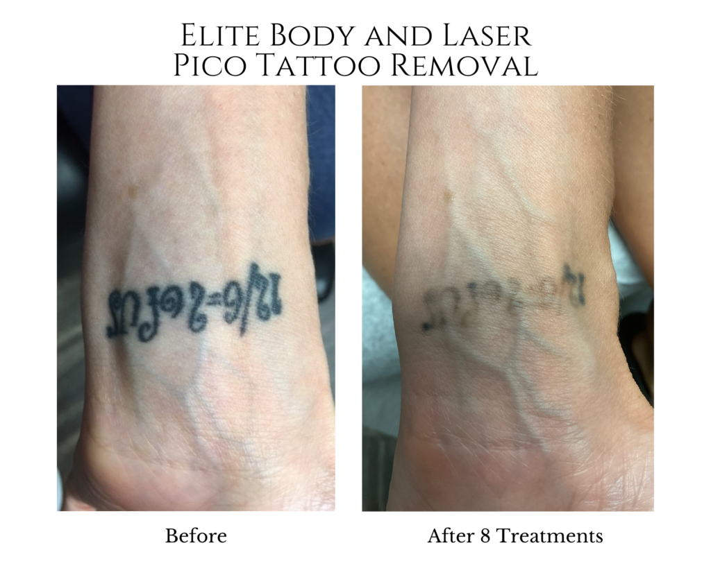 Elite Body and Laser Pico Tattoo Removal