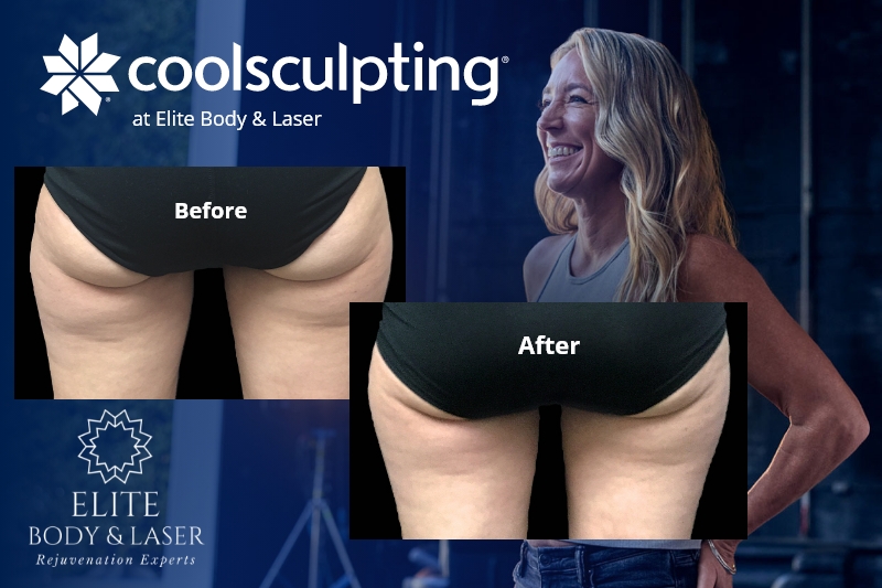 coolsculpting buttox glutes results Elite Body Laser