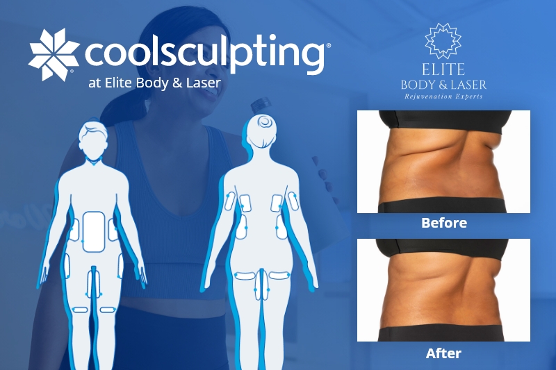 coolsculpting before after belly and hip area