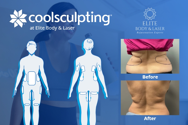 results of Elite Body and Laser coolsculpting program in Columbus ohio