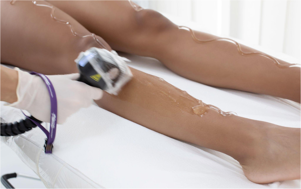 leg of a dark skin woman lying on bed while removing hair using laser technology