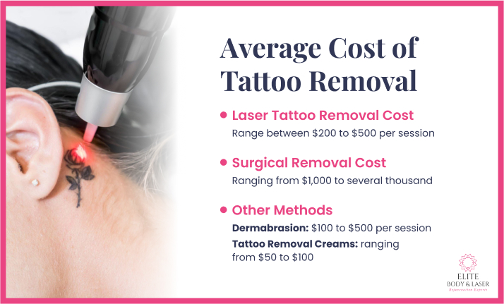 Average Cost of Tattoo Removal