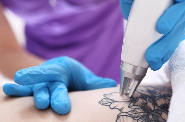Factors Influencing Tattoo Removal Cost