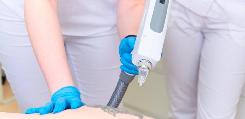 Tattoo Removal laser