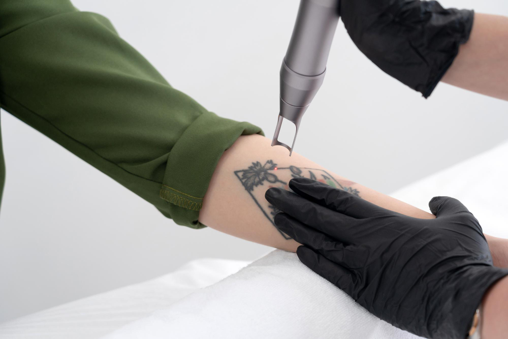 beautician-using-laser-device-remove-unwanted-tattoo-from-female-arm-concept-erasing