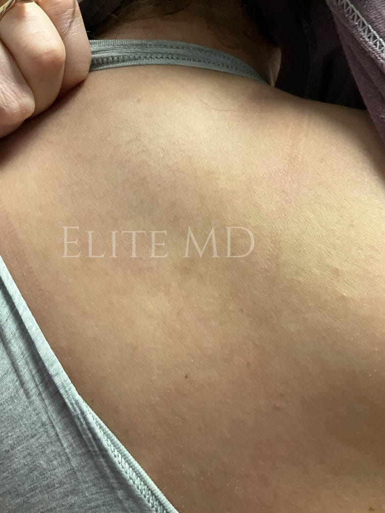 After 4 Treatments