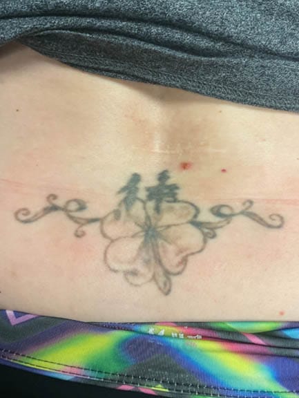 After 2 Treatments