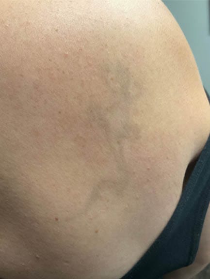 After 2 Treatments